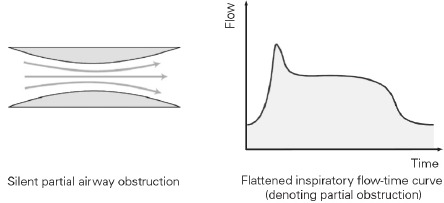 AutoSet-modus metingen - Flowbeperking
