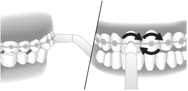 Orthodontische beugels reinigen/Quad Stream-spuitmond